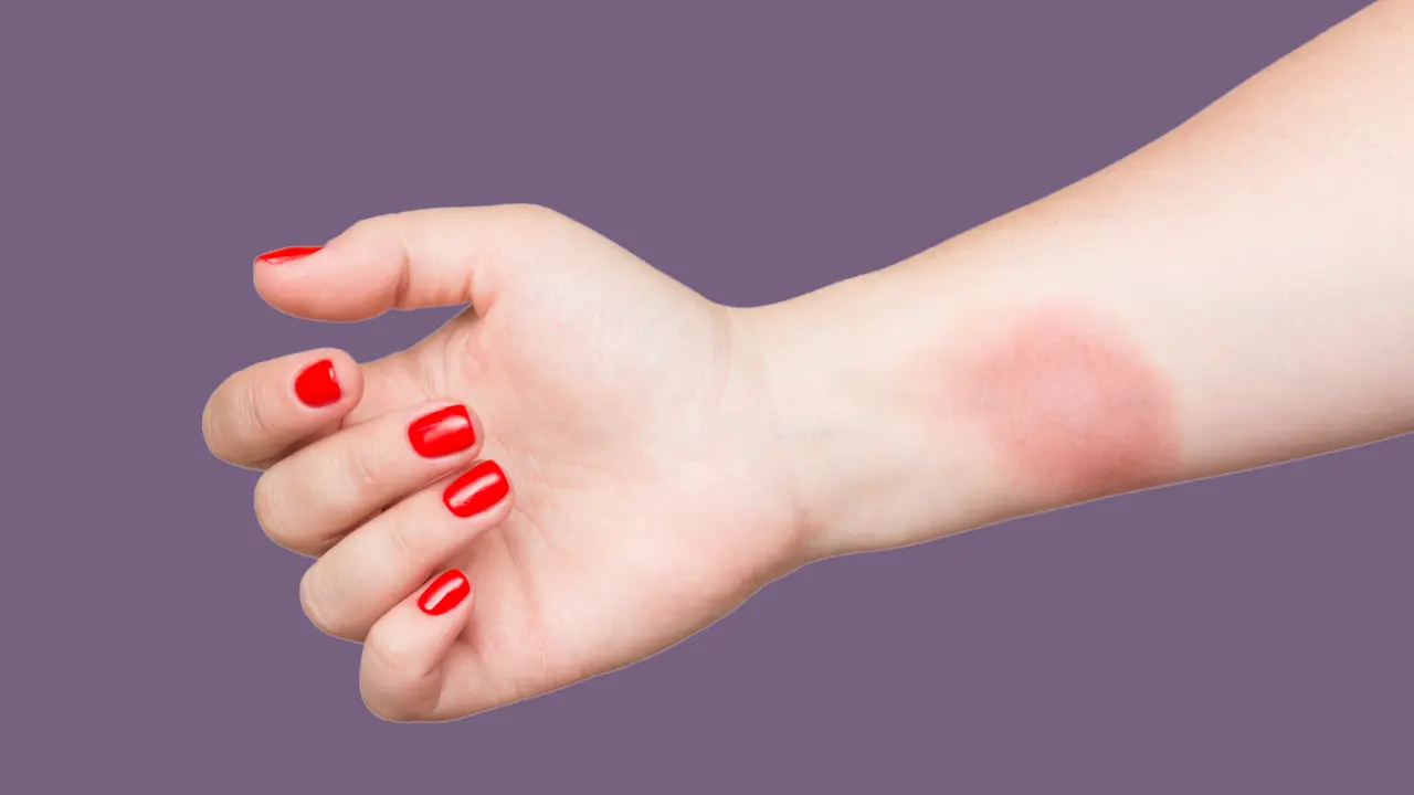 Quemaduras con aceite de cocina: cómo aliviar el dolor y tratarlas adecuadamente - Cómo aliviar el dolor de una quemadura quemadura con aceite de cocina - Cómo aliviar el dolor de una quemadura