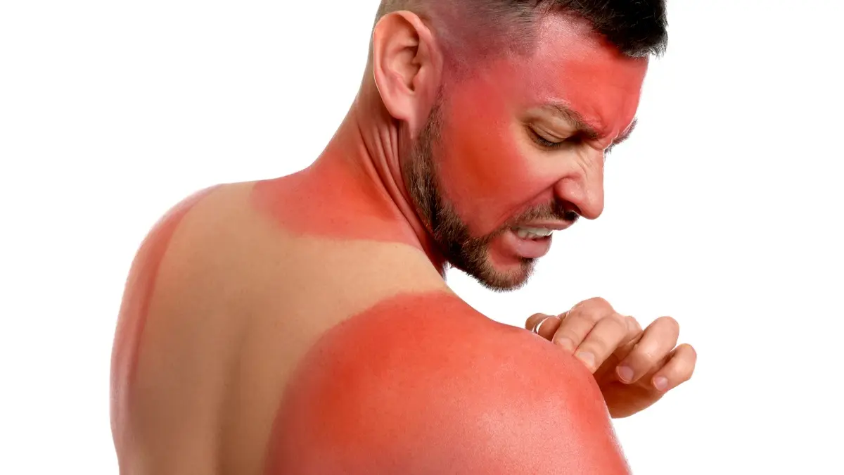 Quemaduras con aceite de cocina: causas, tratamiento y prevención - Cómo quitar el ardor de una quemadura rápido casero quemaduras con aceite de cocina - Cómo quitar el ardor de una quemadura rápido casero
