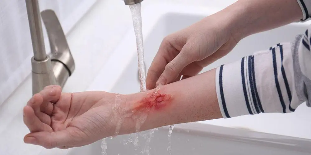 Quemaduras con aceite de cocina: cómo aliviar el dolor y tratarlas adecuadamente - Qué hacer para aliviar el ardor de una quemadura quemadura con aceite de cocina - Qué hacer para aliviar el ardor de una quemadura