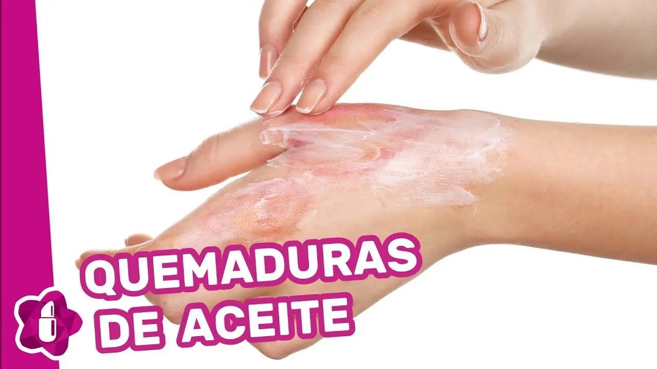 Remedios caseros para quemaduras con aceite de cocina - Qué se le puede echar a una quemadura de aceite remedios caseros para quemaduras con aceite de cocina - Qué se le puede echar a una quemadura de aceite
